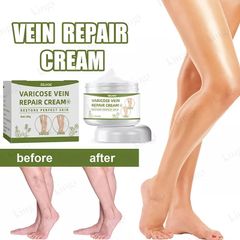  Kem suy giãn tĩnh mạch 50g giúp giảm đau mỏi tê phù chuột rút do suy giãn tĩnh mạch