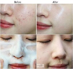 Sữa Rửa Mặt Neutrogena Oil-Free Acne Wash 269ml - Kiềm Dầu, Ngừa Mụn Hiệu Quả, Sản Phẩm Chăm Sóc Da Tốt Vượt Trội