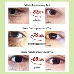 Mụn Thịt Quanh Mắt - Kem Mắt Vitamin E Nguyên Chất Giảm Thâm, Xóa Nhăn, Căng Bóng