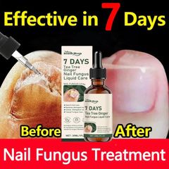 Serum Tẩy Nấm Móng Tay Chân Thảo Mộc Giúp Loại Bỏ Nấm, Kháng Khuẩn, Phục Hồi Móng Cứng Chắc Khỏe Tràm Trà & Gừng 7 DAYS