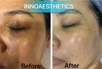 INNOAESTHETICS LIGHTENING A CREAM sản phẩm peel da mụn ẩn, Giải pháp hoàn hảo cho làn da mịn màng và đều màu