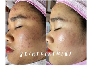 INNOAESTHETICS LIGHTENING A CREAM sản phẩm peel da mụn ẩn, Giải pháp hoàn hảo cho làn da mịn màng và đều màu