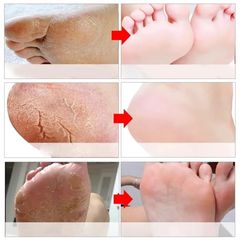 Kem Nứt Gót Chân 20g Thái Lan