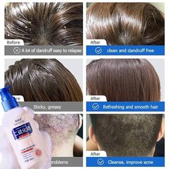 Dầu gội sạch gàu Dầu Gội gội loại bỏ mạt dầu gội giảm ngứa 300ml Làm sạch sâu da đầu, loại bỏ ve, loại