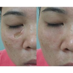 Kem liền sẹo Doctor Spa giúp tái tạo da mau liền sẹo dùng được cho vết thương hở(Tuýt 20g)