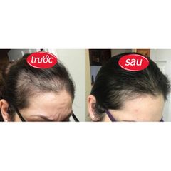 Viên uống hỗ trợ làm đen và dày tóc Kẽm Biotin (Hộp 30viên)