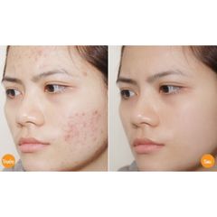 Viên Esunvy hỗ trợ giảm mụn,hạn chế mụn phát triển(Hộp 30viên)