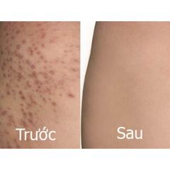 Xịt mụn body và gel tắm ngừa mụn Freeskin hỗ trợ viêm nang lông body