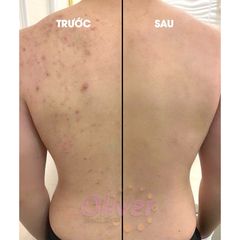 Xịt mụn body và gel tắm ngừa mụn Freeskin hỗ trợ viêm nang lông body