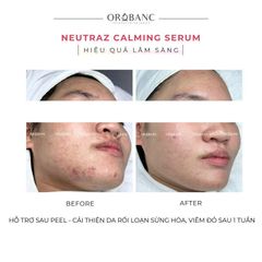 Tinh chất làm dịu, giảm đỏ | NEUTRAZ CALMING SERUM Orobanc