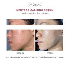 Tinh chất làm dịu, giảm đỏ | NEUTRAZ CALMING SERUM Orobanc