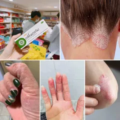 Kem Bôi Clinoderm 15g Thái Lan Ngăn Ngừa Nấm Móng Tay Chân Vảy Nến