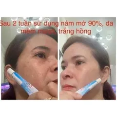 Kem Nám & Tàn Nhan Myda-B của Thái Lan Tuýp 25 gram