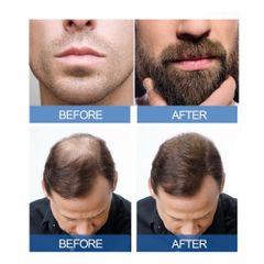 Dung dịch làm dày tóc Minoxidil 5% (60ml/chai)Dầu râu mọc tóc mọc tóc để Hair Growth