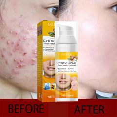 Kem Giảm Mụn Cấp Tốc Loại Bỏ Mụn và Vết Thâm Hoàn ToànThu Nhỏ Lỗ Chân Lông CYSTIC Acne Giúp DaLáng Mịn Khít Lỗ Chân Lông