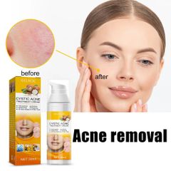 Kem Giảm Mụn Cấp Tốc Loại Bỏ Mụn và Vết Thâm Hoàn ToànThu Nhỏ Lỗ Chân Lông CYSTIC Acne Giúp DaLáng Mịn Khít Lỗ Chân Lông