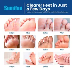 KEM BÔI NẤM ĂN CHÂN BAN ĐÊM–NIGHTTIME ATHLETE’S FOOT CREAM-THẢO MỘC 100%-ÊM-DỊU-NHẸ-RẺ[CHE TÊN KHI GIAO]