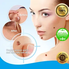 Kem Xóa Nốt Ruồi, Tàn Nhang, Mụn Thịt, Mụn Cóc, thành phần thảo dược thiên nhiên, giá rẻ và an toàn