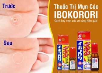 Dung dịch bôi mụn cóc, chai chân, chai tay Ibokorori Nhật Bản 10ml