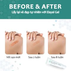 [TOP] Gel Mờ Sẹo Elayal Gel - Nhập Khẩu Italia Chuẩn Y Khoa, Chuyên Sẹo Lồi, Sẹo Lõm, Sẹo Cũ Và Sẹo Mới Tuýp 15ml