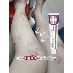 Bán chạy WJG kem Giảm ngứa do muỗi đốt hỗ trợ cải thiện các vấn đề da