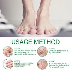 Nấm móng tay Loại bỏ nguyên nhân gốc rễ của nấm Sửa chữaa móng tay bị hư hỏng