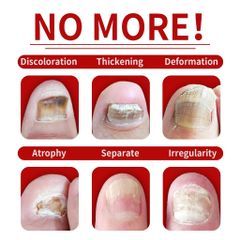 Nấm móng tay Loại bỏ nguyên nhân gốc rễ của nấm Sửa chữaa móng tay bị hư hỏng