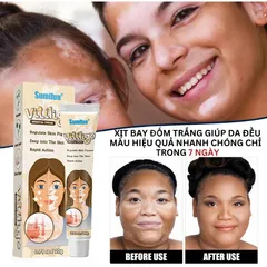 Kem đốm trắng Vitiligo removal cream kem làm sạch bạch biến chăm sóc da làm giảm các đốm trắng trên