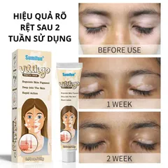 Kem đốm trắng Vitiligo removal cream kem làm sạch bạch biến chăm sóc da làm giảm các đốm trắng trên