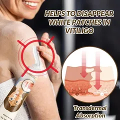 Kem đốm trắng Vitiligo removal cream kem làm sạch bạch biến chăm sóc da làm giảm các đốm trắng trên