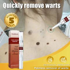 Gel thảoo dượcc: xoá nốt ruồi, mụn cóc, tàn nhang, mụn thịt – Lành tính, không đau, ngừa sẹo lồi ，Tiện lợi sử dụng tại nhà