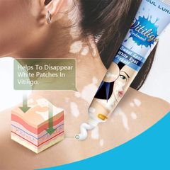 Kem Bôi Bạch Biến Kem Lang Ben Mờ Đốm Trắng, Nâu Đốm Trắng Giúp Da Đều Màu