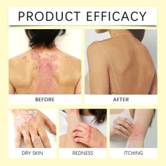 Xịt Giảm Ngứa giảm ngứa tức thì, viêm da cơ địa, nấm, ngứa... hiệu quả