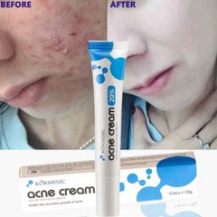 AZELAIC ACID Kem chấm mụn bỏ các loại mụn, mụn đầu đen,mụn ở tuổi dậy thì,loại bỏ mụn bọc cho da dầu