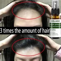 Xịt Mọc Tóc , Giảm Rụng Tóc Và Kích Thích Mọc Tóc