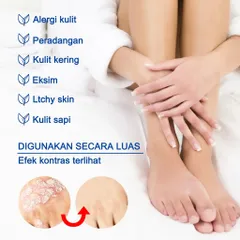 Kem hỗ trợ giảm ngứa do nấm, viêm da cơ địa, hắc lào, tổ đỉa, vẩy nến, á sừng, lang ben