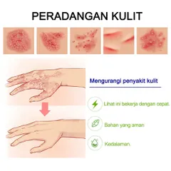 Kem hỗ trợ giảm ngứa do nấm, viêm da cơ địa, hắc lào, tổ đỉa, vẩy nến, á sừng, lang ben