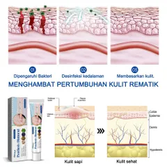 Kem hỗ trợ giảm ngứa do nấm, viêm da cơ địa, hắc lào, tổ đỉa, vẩy nến, á sừng, lang ben