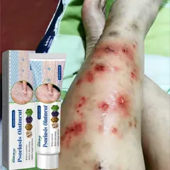 Kem hỗ trợ giảm ngứa do nấm, viêm da cơ địa, hắc lào, tổ đỉa, vẩy nến, á sừng, lang ben
