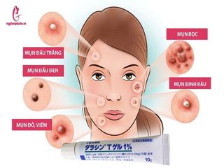 Kem Giảm Mụn Dalacinn T Gel 1% Sato Nhật Bản 10gr - Hỗ Trợ Làm Sạch Da, Ngăn Ngừa Tái Phát Mụn, Giảm Viêm Đỏ, Dưỡng Ẩm Da