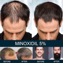 Xịt mọc tóc Minoxidil 5% BAILLEUL - Giảm rụng tóc, kích thích mọc tóc hiệu quả cho nam và nữ - Best Seller Pháp