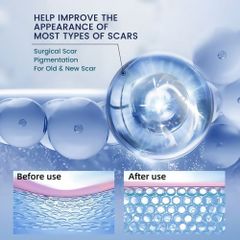 Kem sẹo kem mờ sẹo kem bôi sẹo mờ sẹo 40g kem mờ sẹo thâm mờ thâm sẹo kem liền sẹo loại bỏ sẹo mụn trứng cá