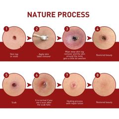 [Loại Xịn]Tẩy nốt ruồi mụn cóc, mụn thịt, dưỡng da, kháng khuẩn, tinh chất thảoo dượcc thiên nhiên, ann toànn