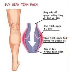 Kem bôi chống giãn tĩnh mạch MIVOLIS, tuýp 125ml