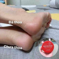 Kem nẻ, dưỡng ẩm GLYSOLID cho da chân tay khô, nứt. Hộp 100ml