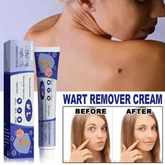 Kem Bôi Rụng Mụn Thịt Thừa & Mụn Cóc 20g - Giải Pháp Làm Sạch Da Tự Nhiên