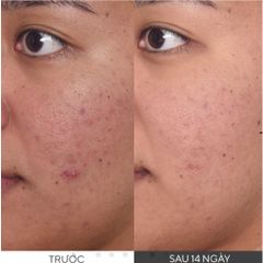 Tinh Chất Làm Mờ Thâm Nám Murad Rapid Dark Spot Correcting Serum 5ml