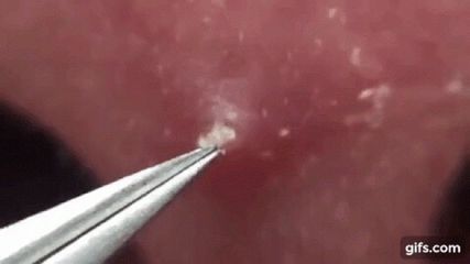 Combo 20 cây Kim Lấy Mụn hỗ trợ lấy mụn