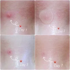 24 miếng] Miếng Dán Mụn Giúp Làm Dịu Và Hút Dịch Mủ Ciracle Red Spot Acne Pimple Patch