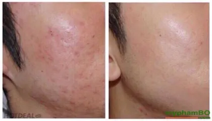 Cây lăn kim tay trị rỗ sẹo thâm, thu nhỏ lỗ chân lông ZGTS – Mỹ